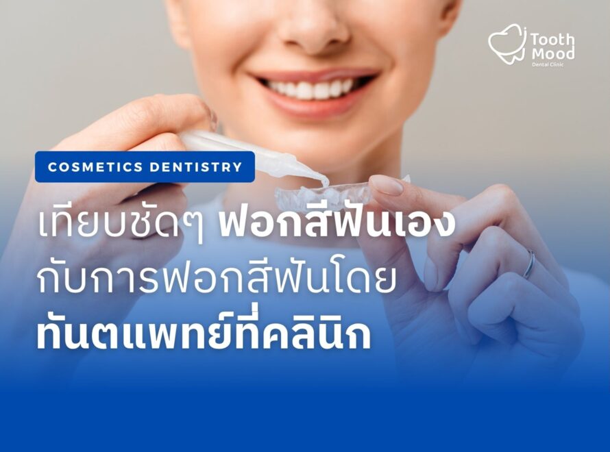 ฟอกสีฟันที่บ้าน vs. ที่คลินิก